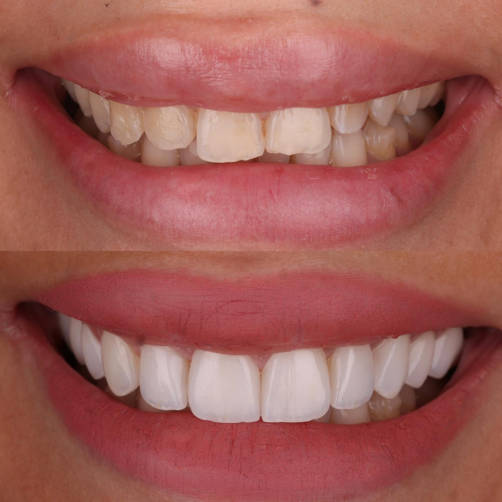 Résultat avant après facettes céramique — Medit Smile Clinic Mantes-la-Jolie