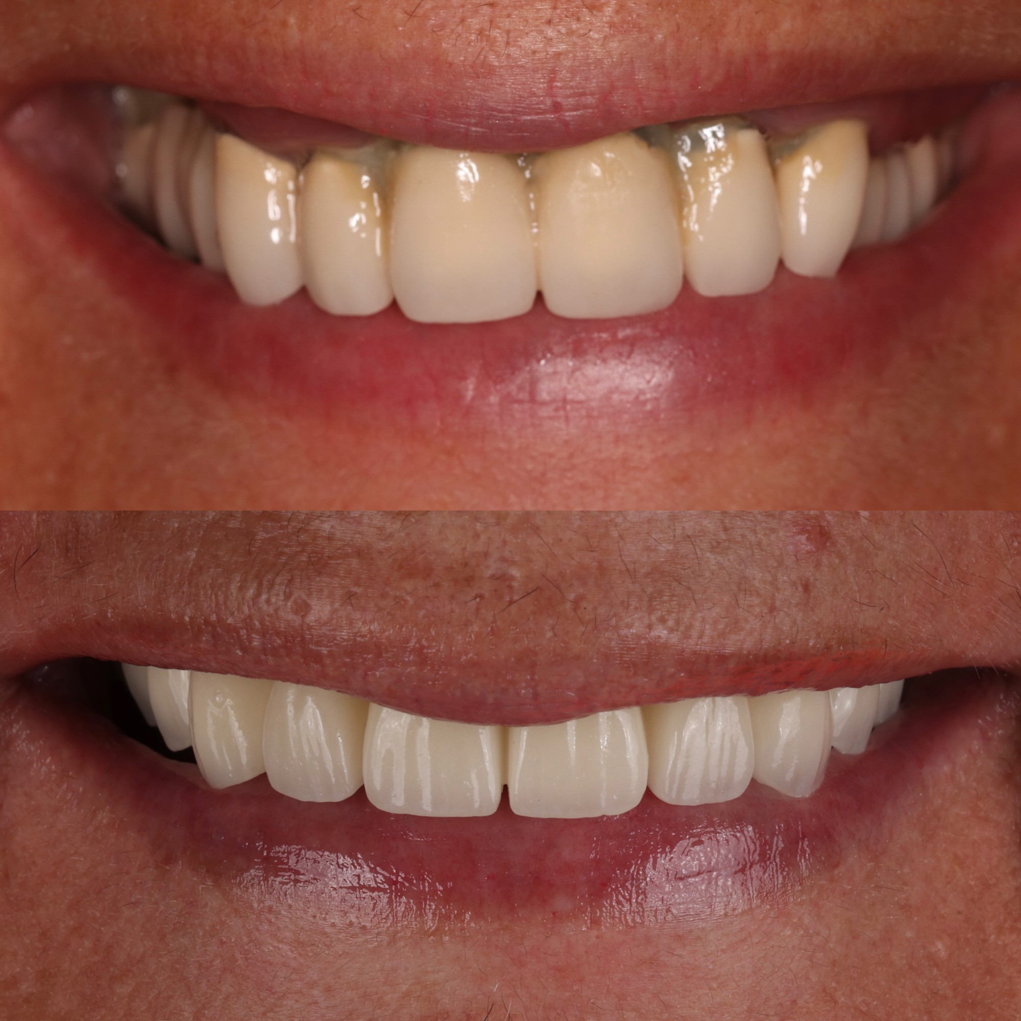 Résultat avant après traitement dentaire par le Dr Nurisso — Medit Smile Clinic Mantes-la-Jolie