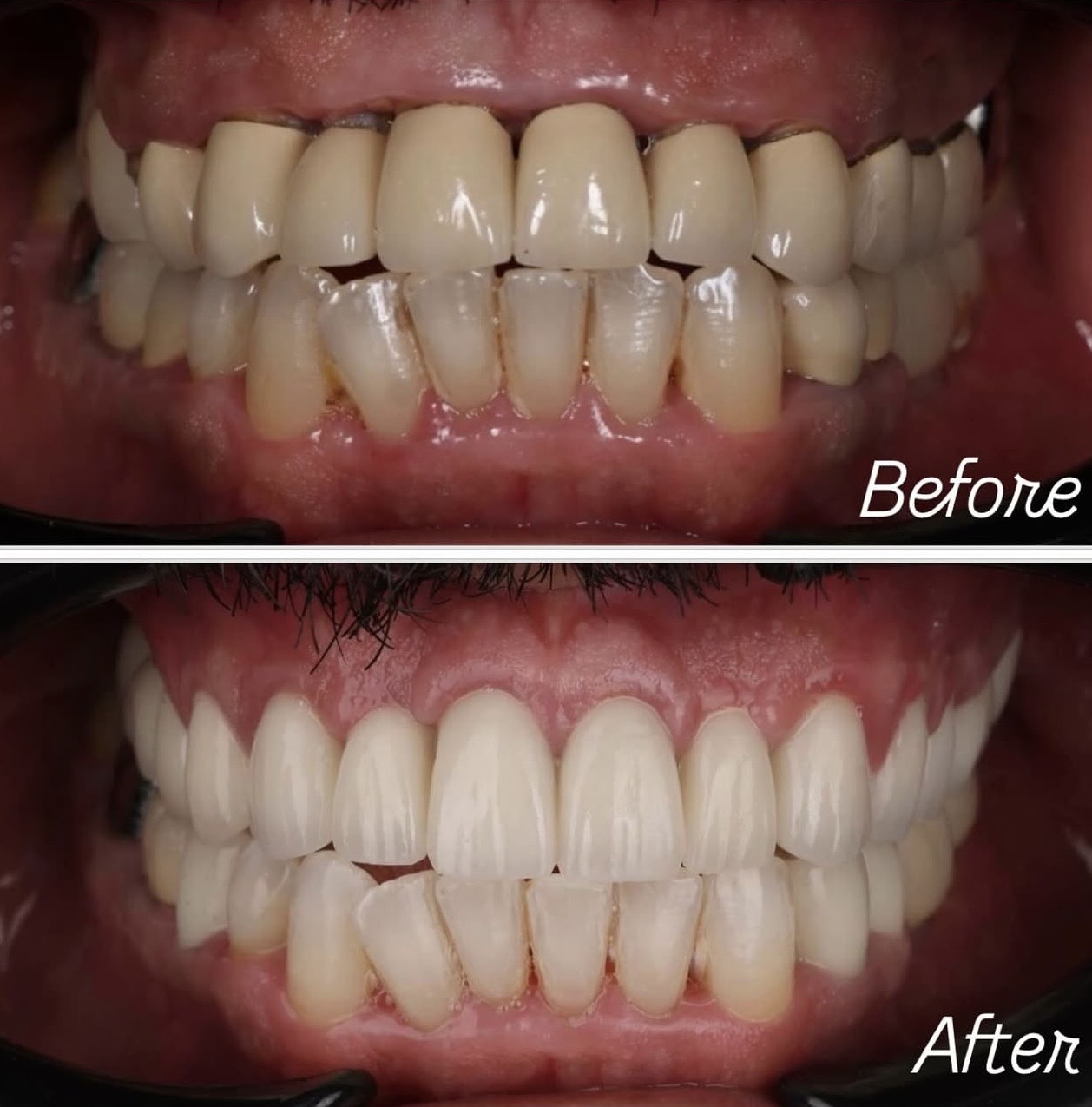 Résultat avant après traitement dentaire par le Dr Nurisso — Medit Smile Clinic Mantes-la-Jolie