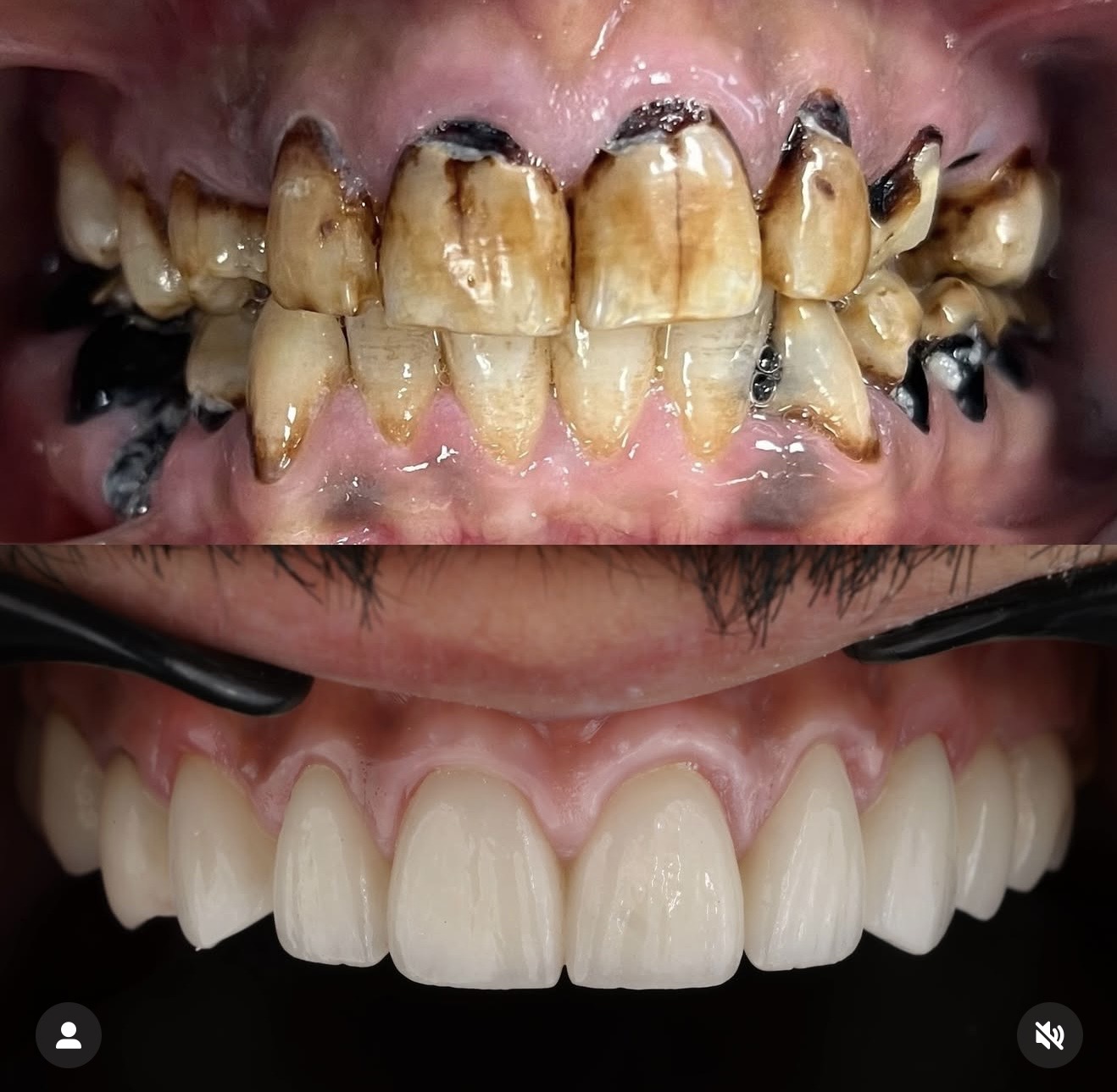 Résultat avant après traitement dentaire par le Dr Nurisso — Medit Smile Clinic Mantes-la-Jolie