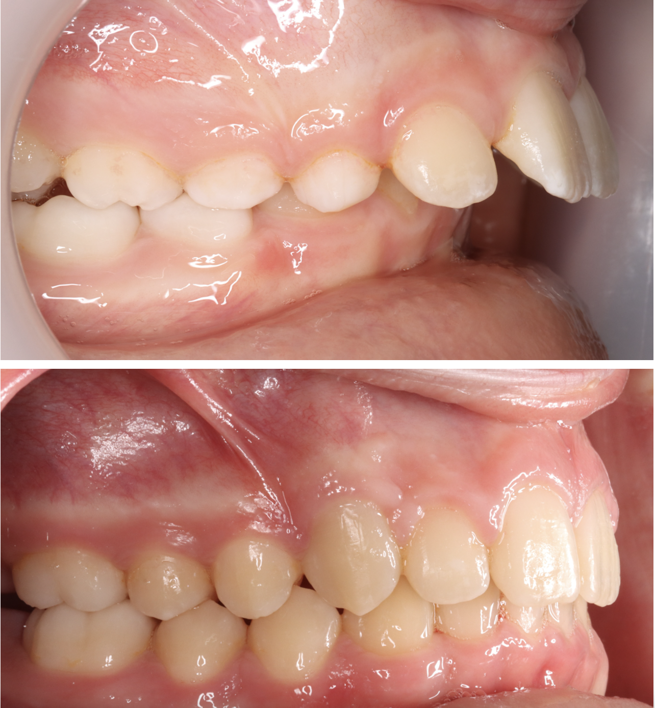 Résultat avant après orthodontie — Medit Smile Clinic Mantes-la-Jolie