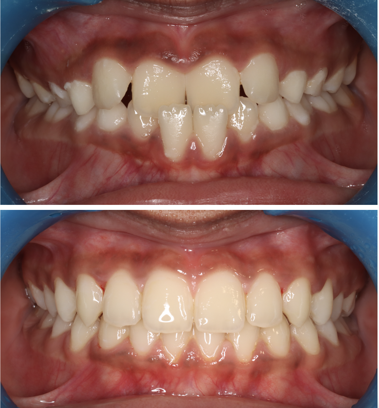 Résultat avant après orthodontie — Medit Smile Clinic Mantes-la-Jolie