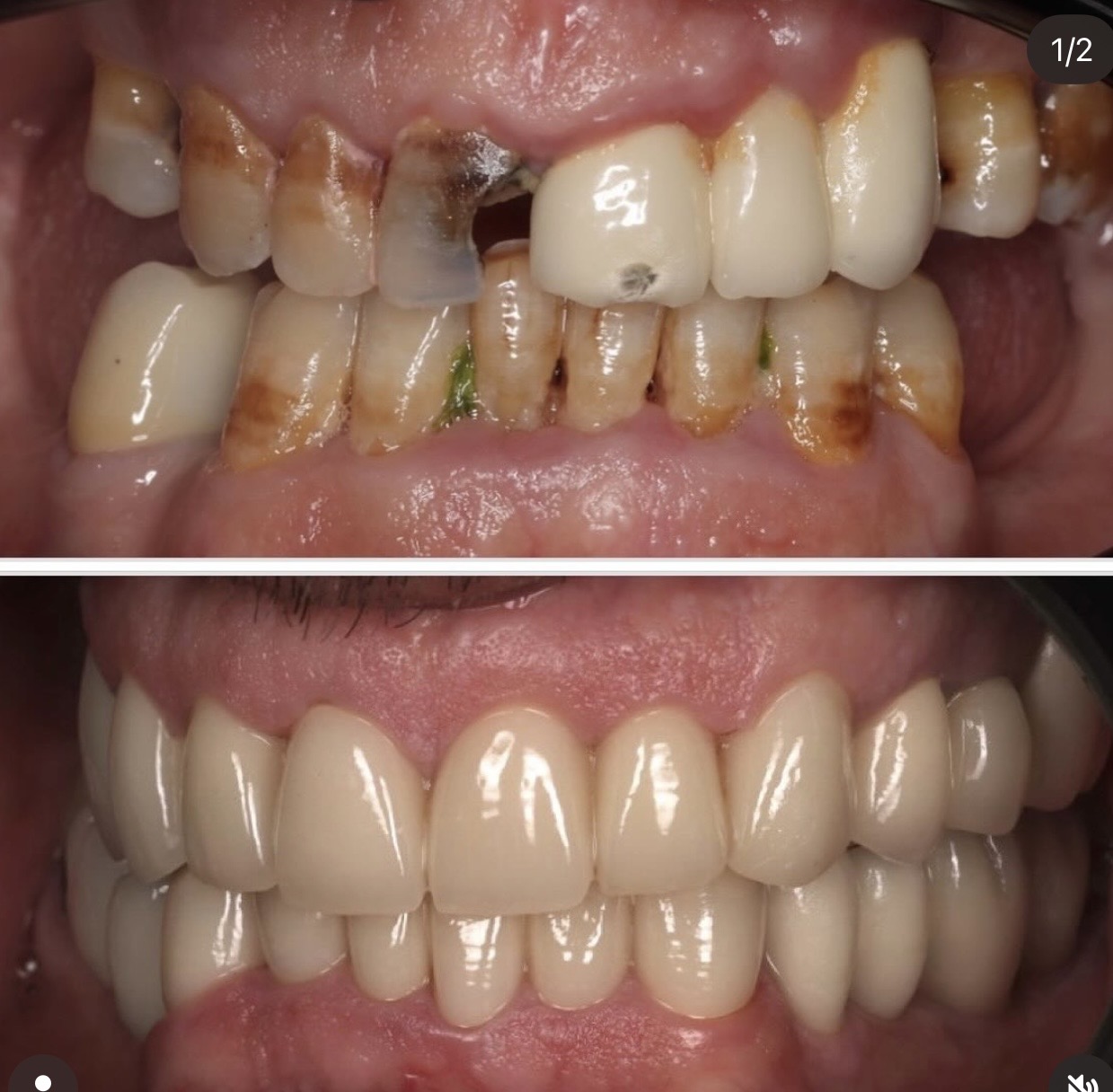 Résultat avant après réhabilitation dentaire complète — Medit Smile Clinic Mantes-la-Jolie