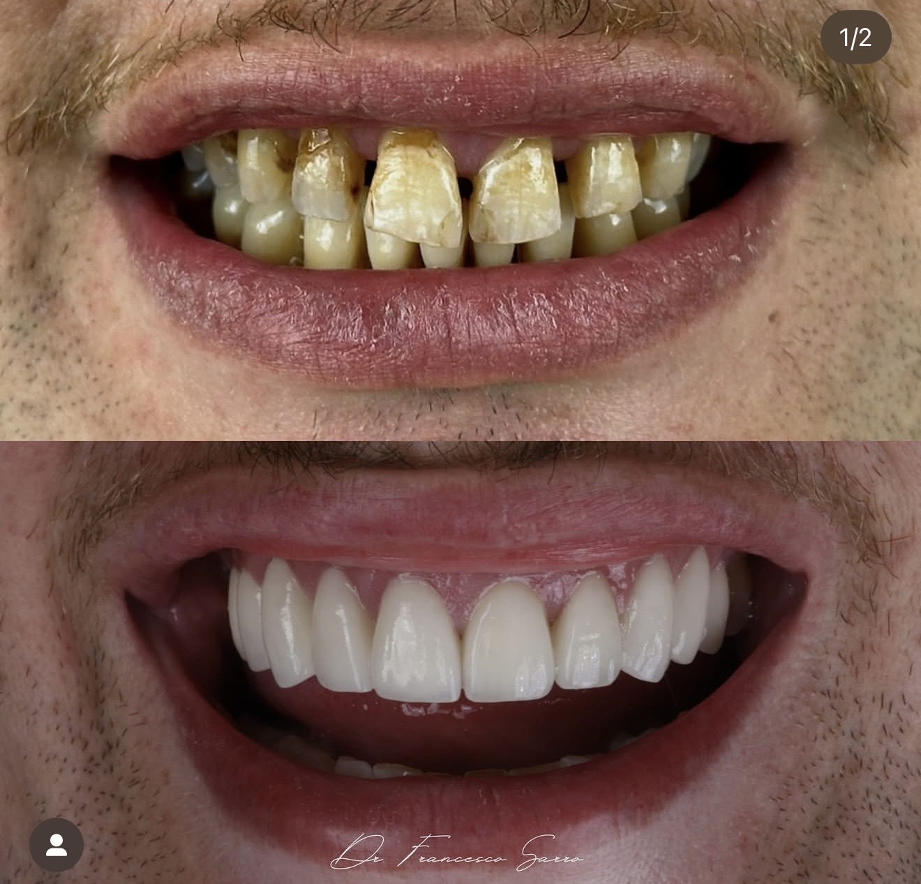 Résultat avant après facettes céramique par le Dr Sarro — Medit Smile Clinic Mantes-la-Jolie